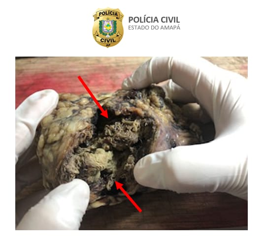 POLÍCIA CIVIL INDICIA MÉDICO QUE ESQUECEU GAZE DENTRO DE CORPO DE PACIENTE